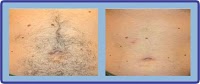 Laser Hair Removal Group 380384 Image 9